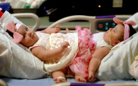 This Feb. 10, 2016 photo provided by Driscoll Children's Hospital shows conjoined twin sisters Scarlett, left, and Ximena Hernandez-Torres at Dirscoll Children's Hospital in Corpus Christi, Texas. Doctors in Texas will attempt to separate the two 10-month-old sisters born conjoined below the waist. The girls share a colon and bladders that will be reconstructed. Their identical triplet sister, Catalina, was born without serious health issues. (Joshua Thelin/Driscoll Children's Hospital via AP)
