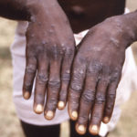 
              FILE - This 1997 image provided by the CDC during an investigation into an outbreak of monkeypox, which took place in the Democratic Republic of the Congo (DRC), formerly Zaire, depicts the dorsal surfaces of the hands of a monkeypox case patient, who was displaying the appearance of the characteristic rash during its recuperative stage. With monkeypox cases subsiding in Europe and parts of North America in 2022, many scientists say now is the time to prioritize stopping the virus in Africa. (CDC via AP, File)
            