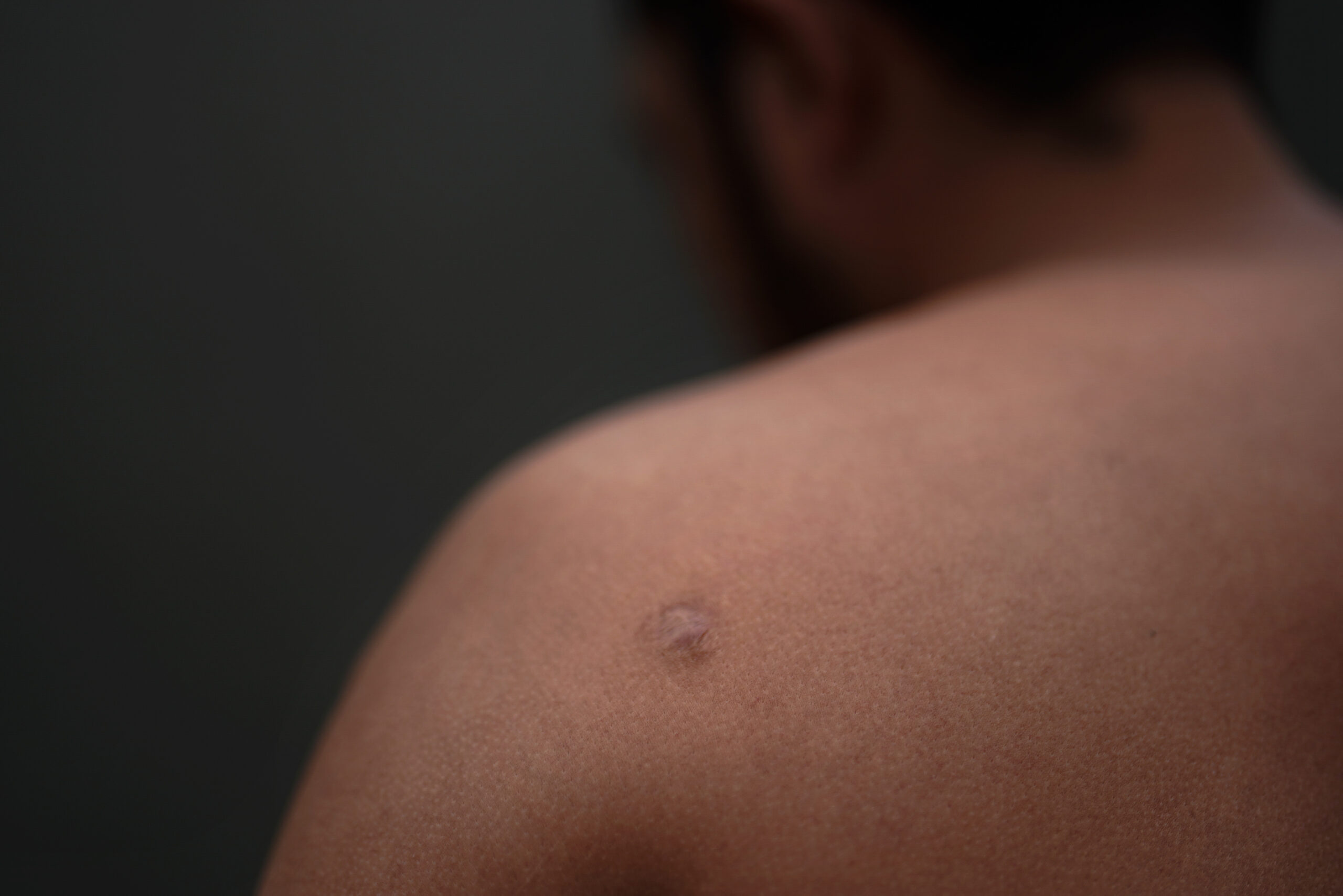 Asylum seeker Teodoso Vargas shows bullet wounds to his torso, after being shot nine times during a...