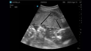 Photo: Ultrasound of Akenji's baby. Akenji is a gorilla at the Woodland Park Zoo. 