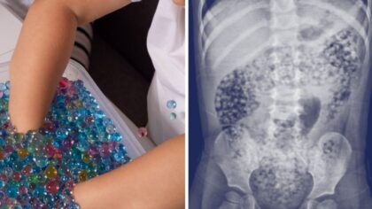 Water bead toys face new federal safety rules after thousands of children injured