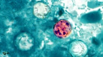 At least 1 WA resident sick from 'explosive' diarrhea parasite surge; Taco Bell under investigation
