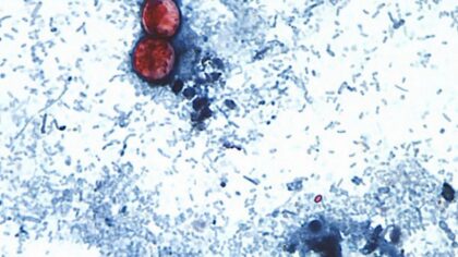 Michigan reports the first 2 US deaths related to a diarrhea-causing parasite