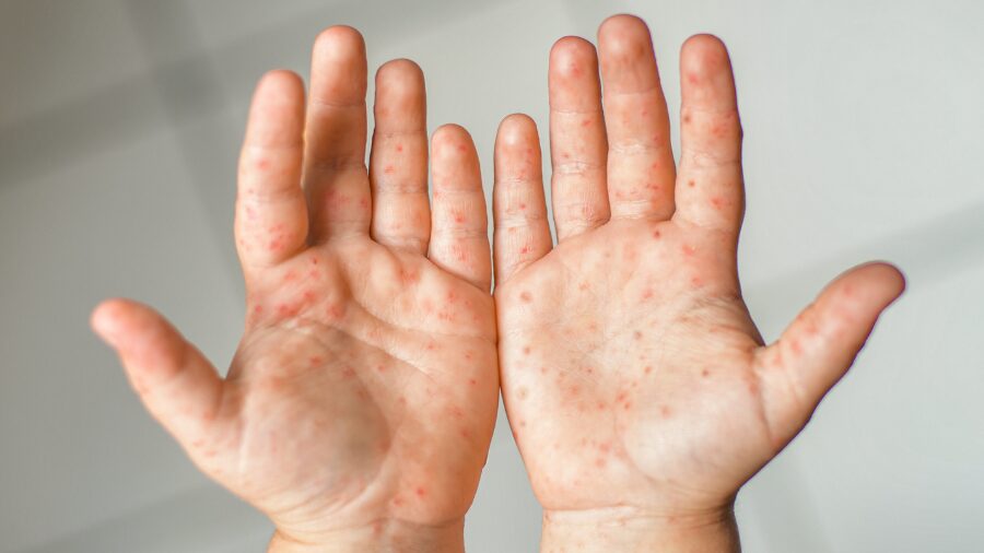 measles...